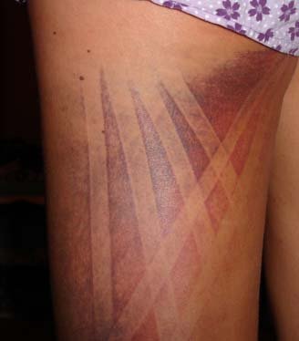 Kinesiology tape (Limfna drenaža).jpg